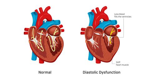 grade 1 lv diastolic dysfunction|what is the meaning of grade 1 diastolic dysfunction.